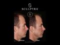 sculptra