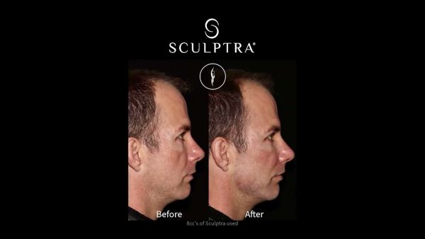 sculptra