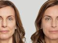 sculptra before after v1