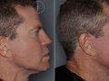 sculptra before after v2