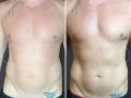 sculpsure before after v1