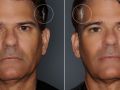 ultherapy before after v1