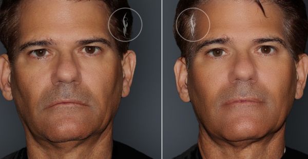 ultherapy before after v1