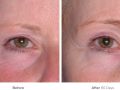 ultherapy before after v10