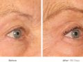 ultherapy before after v11