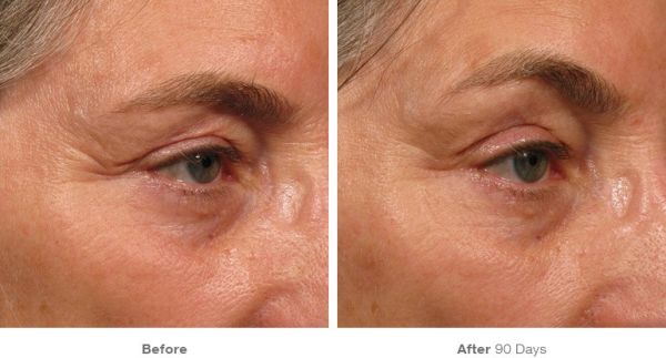 ultherapy before after v2