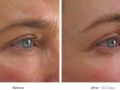 ultherapy before after v6