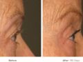 ultherapy before after v8