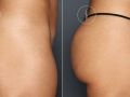 booty enhancement before after v1