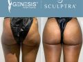 sculptra booty social media images3