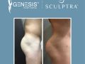 sculptra booty social media images4