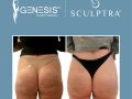 sculptra booty social media images6